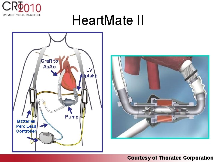 Heart. Mate II Graft to As. Ao Batteries Perc Lead Controller LV Uptake Pump