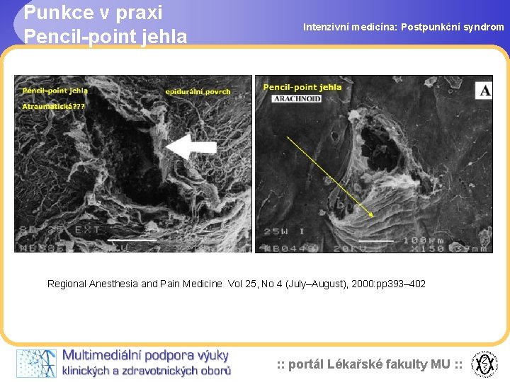 Punkce v praxi Pencil-point jehla Intenzivní medicína: Postpunkční syndrom Regional Anesthesia and Pain Medicine