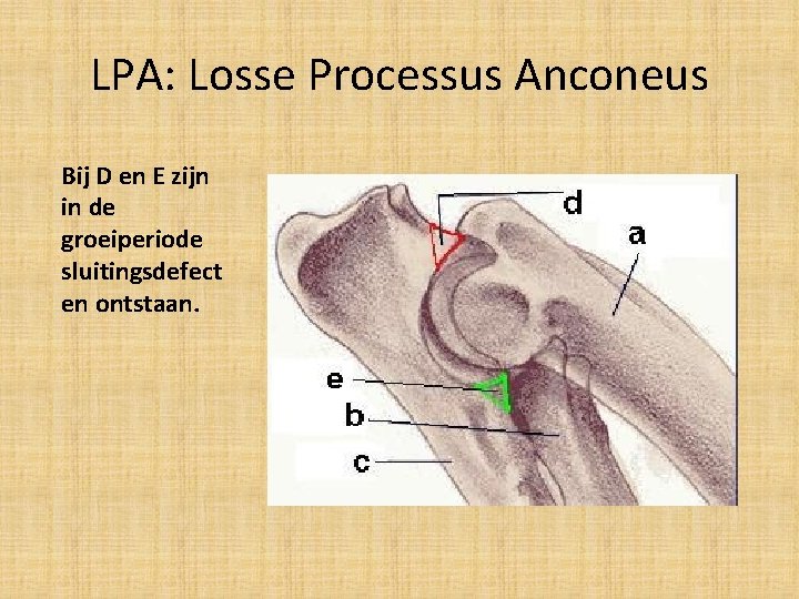 LPA: Losse Processus Anconeus Bij D en E zijn in de groeiperiode sluitingsdefect en