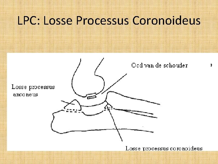 LPC: Losse Processus Coronoideus 