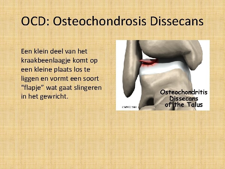 OCD: Osteochondrosis Dissecans Een klein deel van het kraakbeenlaagje komt op een kleine plaats