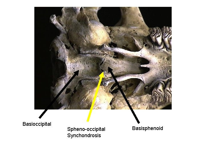 Basioccipital Spheno-occipital Synchondrosis Basisphenoid 