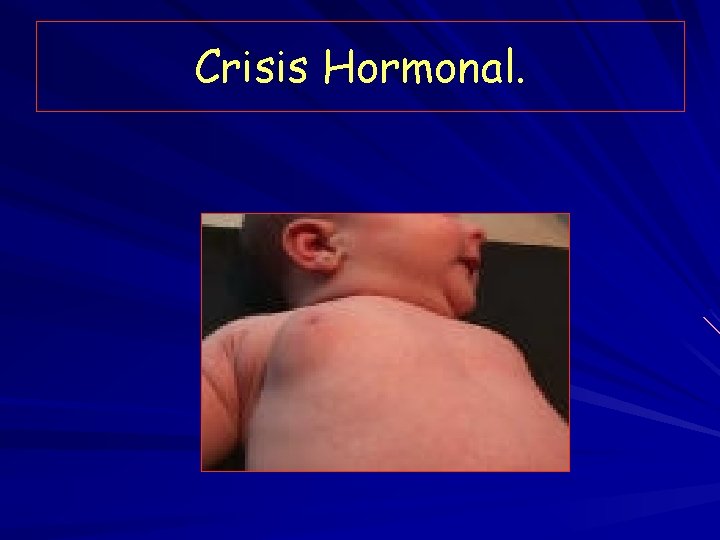 Crisis Hormonal. 