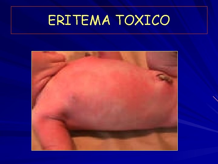 ERITEMA TOXICO 