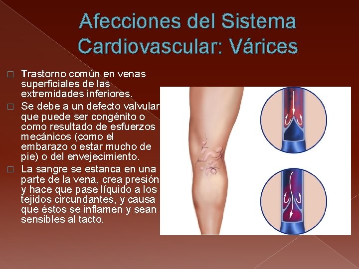 Afecciones del Sistema Cardiovascular: Várices Trastorno común en venas superficiales de las extremidades inferiores.