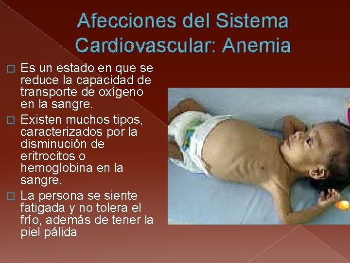 Afecciones del Sistema Cardiovascular: Anemia Es un estado en que se reduce la capacidad