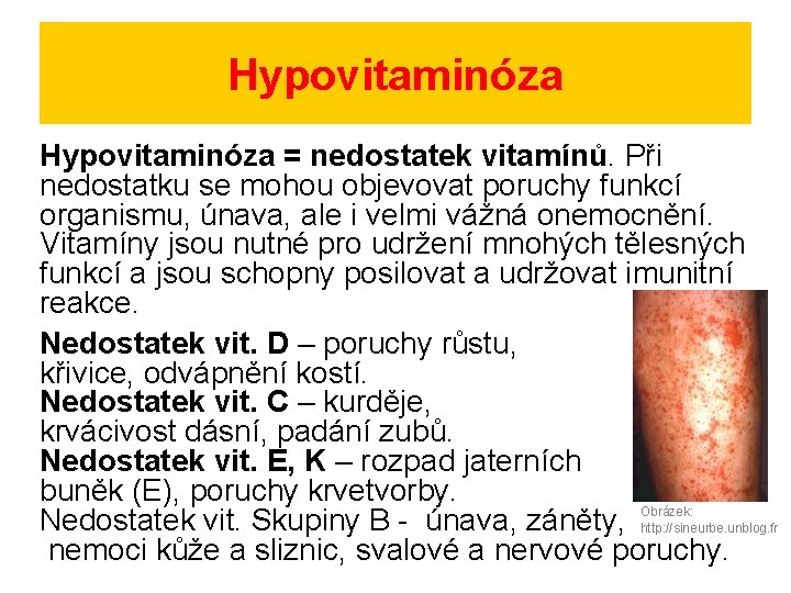 Hypovitaminóza = nedostatek vitamínů. Při nedostatku se mohou objevovat poruchy funkcí organismu, únava, ale