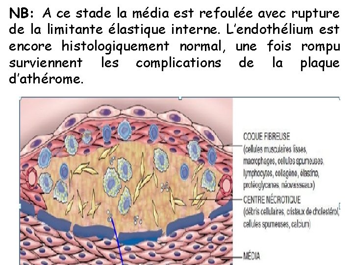 NB: A ce stade la média est refoulée avec rupture de la limitante élastique