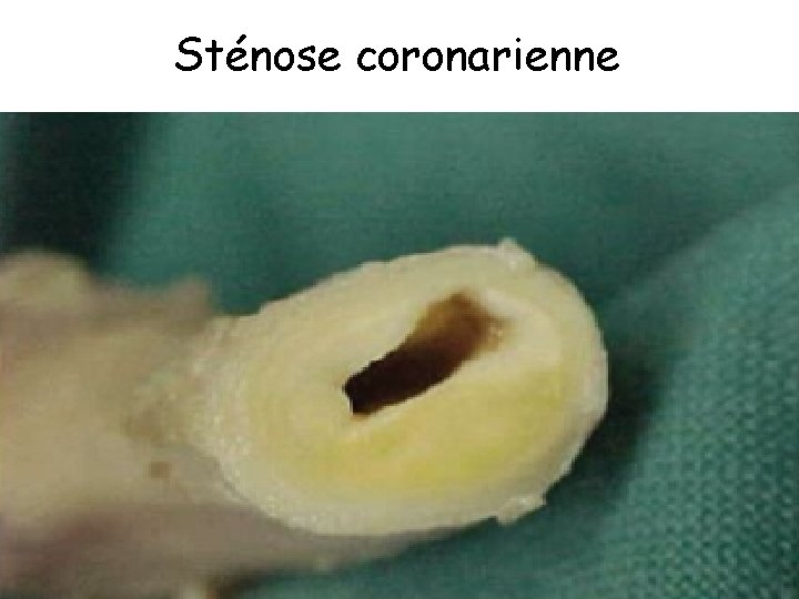 Sténose coronarienne 