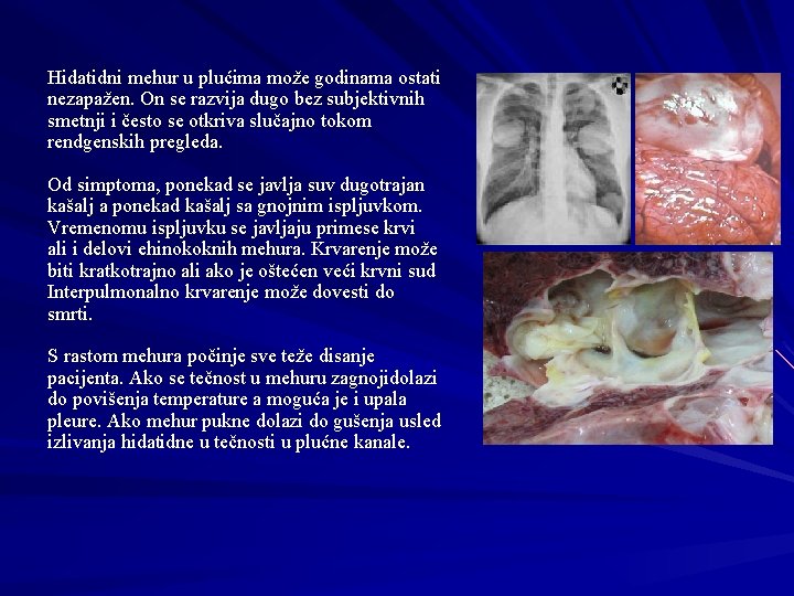 Hidatidni mehur u plućima može godinama ostati nezapažen. On se razvija dugo bez subjektivnih