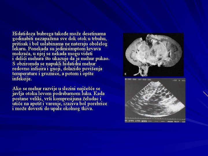 Hidatidoza bubrega takođe može desetinama godinabiti nezapažena sve dok otok u trbuhu, pritisak i