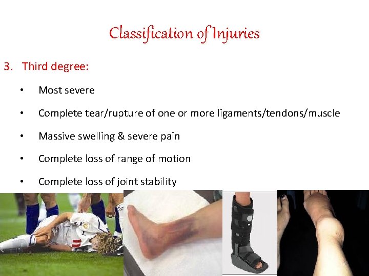 Classification of Injuries 3. Third degree: • Most severe • Complete tear/rupture of one