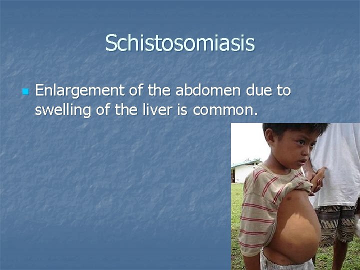 Schistosomiasis n Enlargement of the abdomen due to swelling of the liver is common.