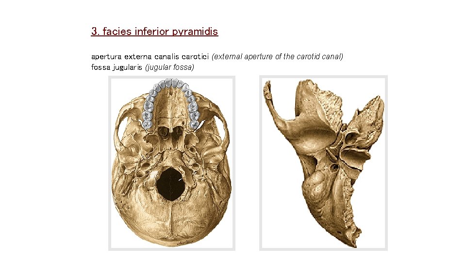 3. facies inferior pyramidis apertura externa canalis carotici (external aperture of the carotid canal) 3. facies inferior pyramidis apertura externa canalis carotici (external aperture of the carotid canal)