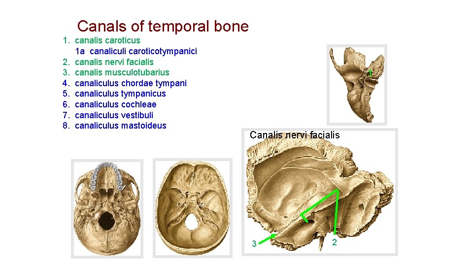 Canals of temporal bone 1. canalis caroticus 1 a canaliculi caroticotympanici 2. canalis nervi Canals of temporal bone 1. canalis caroticus 1 a canaliculi caroticotympanici 2. canalis nervi