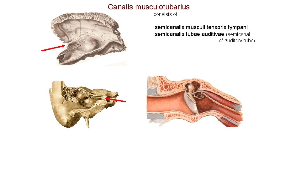 Canalis musculotubarius consists of: semicanalis musculi tensoris tympani semicanalis tubae auditivae (semicanal of auditory Canalis musculotubarius consists of: semicanalis musculi tensoris tympani semicanalis tubae auditivae (semicanal of auditory