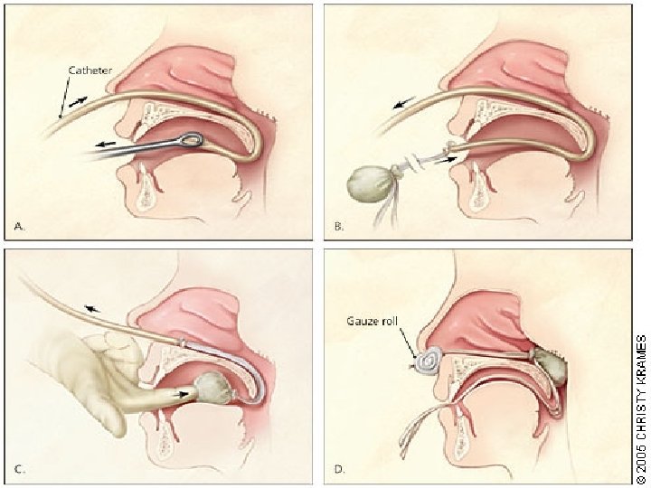  • Done by Otolaryngologist • A catheter is passed through the nostril and