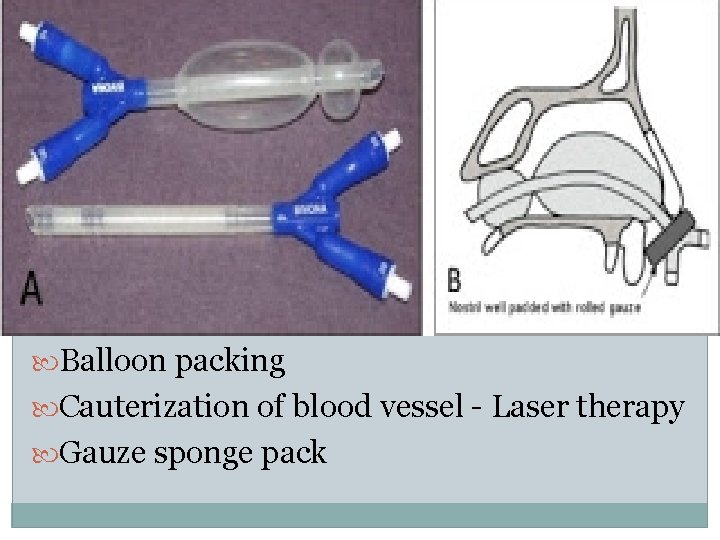 Other treatments Balloon packing Cauterization of blood vessel - Laser therapy Gauze sponge pack