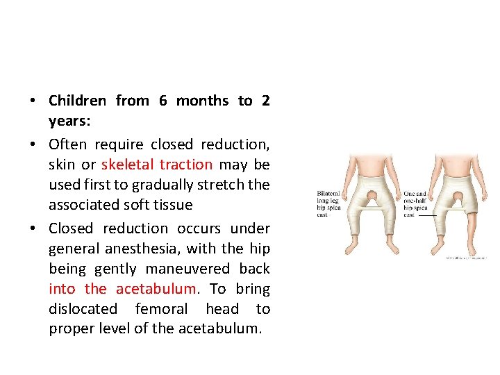  • Children from 6 months to 2 years: • Often require closed reduction,