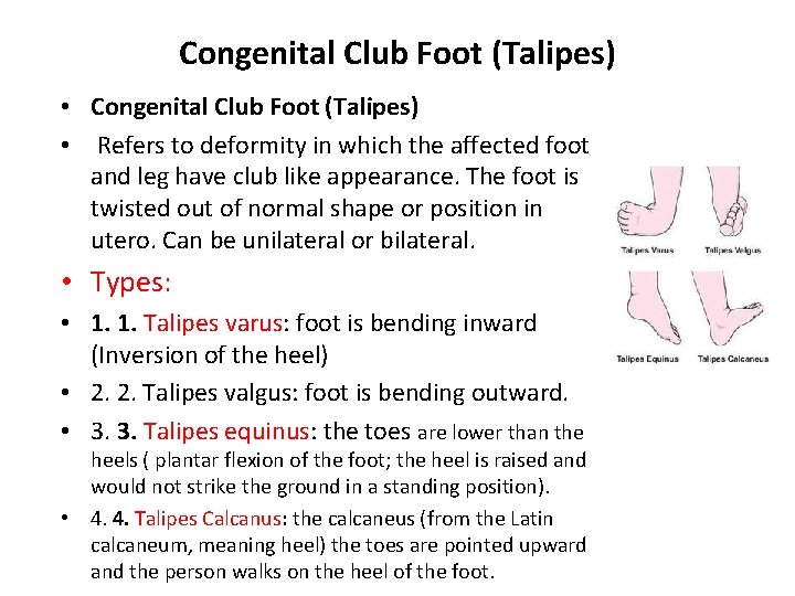 Congenital Club Foot (Talipes) • Refers to deformity in which the affected foot and