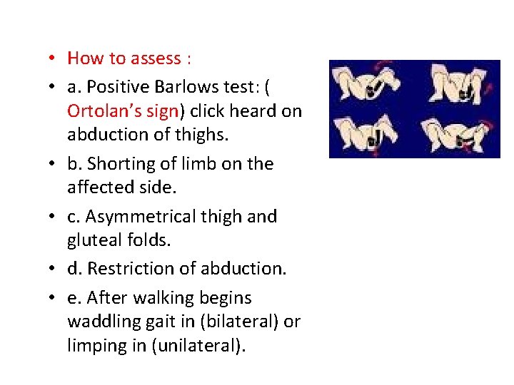  • How to assess : • a. Positive Barlows test: ( Ortolan’s sign)