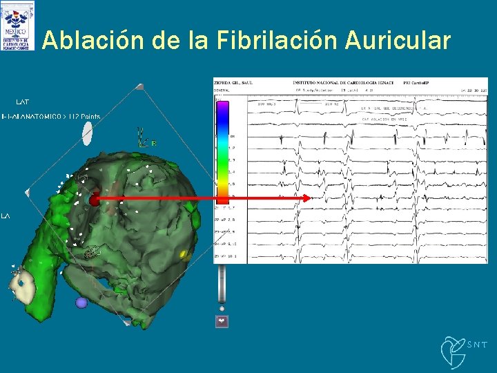 Ablación de la Fibrilación Auricular SNT 
