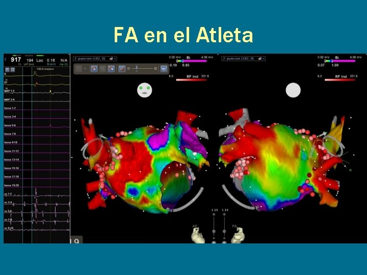FA en el Atleta 