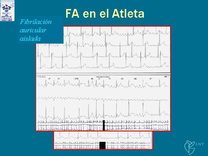 Fibrilación auricular aislada FA en el Atleta SNT 