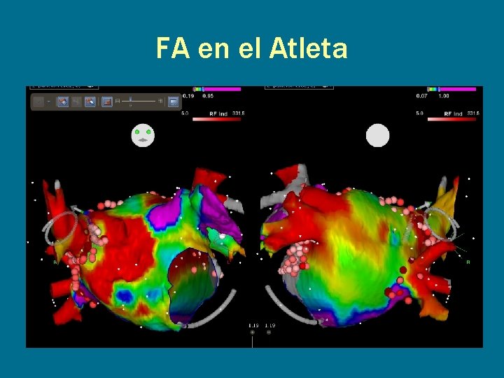 FA en el Atleta 