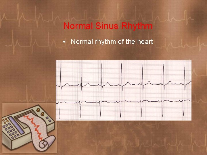 Normal Sinus Rhythm • Normal rhythm of the heart 