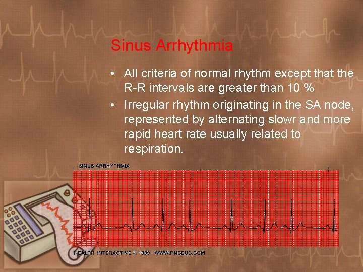 Sinus Arrhythmia • All criteria of normal rhythm except that the R-R intervals are