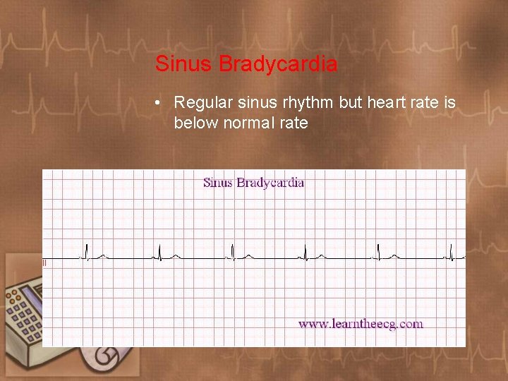 Sinus Bradycardia • Regular sinus rhythm but heart rate is below normal rate 