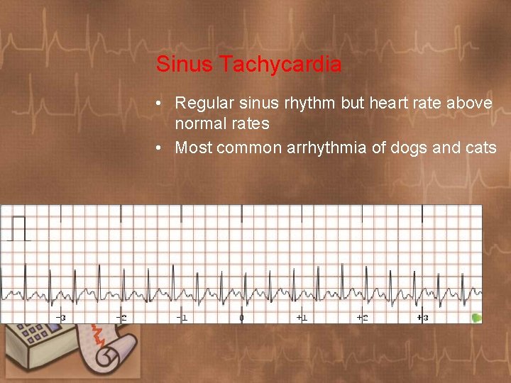 Sinus Tachycardia • Regular sinus rhythm but heart rate above normal rates • Most