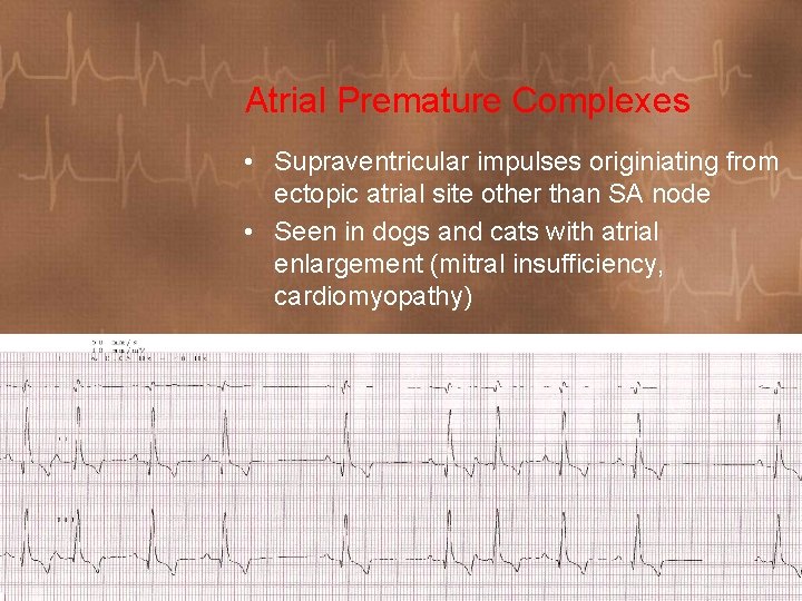 Atrial Premature Complexes • Supraventricular impulses originiating from ectopic atrial site other than SA