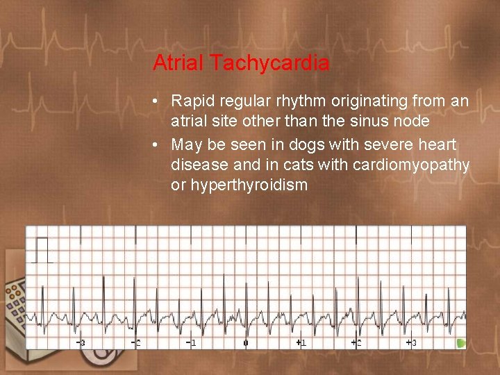 Atrial Tachycardia • Rapid regular rhythm originating from an atrial site other than the