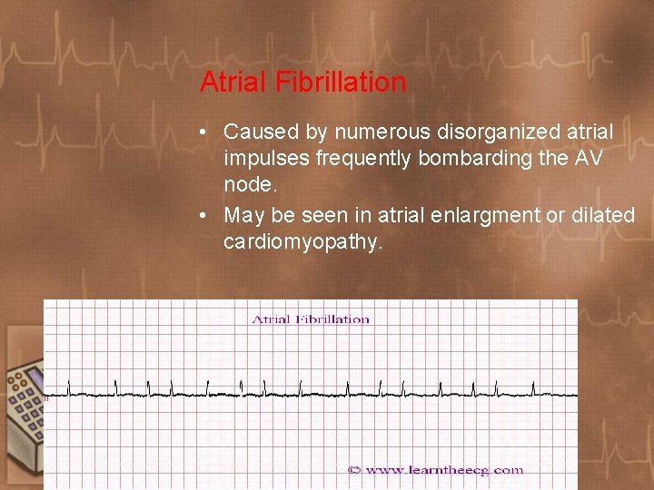 Atrial Fibrillation • Caused by numerous disorganized atrial impulses frequently bombarding the AV node.