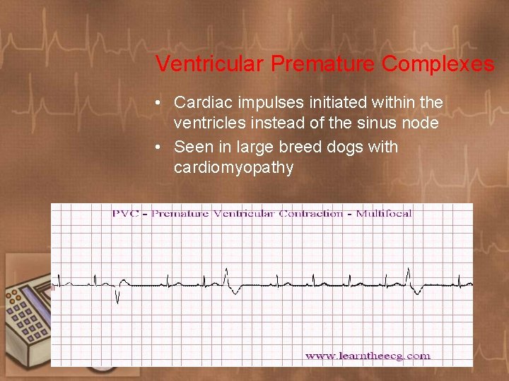 Ventricular Premature Complexes • Cardiac impulses initiated within the ventricles instead of the sinus