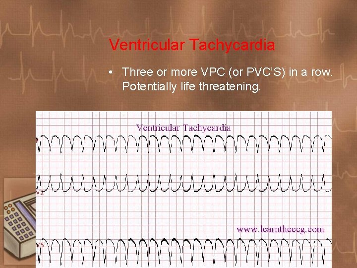 Ventricular Tachycardia • Three or more VPC (or PVC’S) in a row. Potentially life