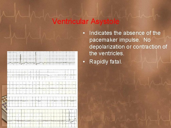 Ventricular Asystole • Indicates the absence of the pacemaker impulse. No depolarization or contraction