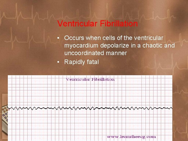 Ventricular Fibrillation • Occurs when cells of the ventricular myocardium depolarize in a chaotic