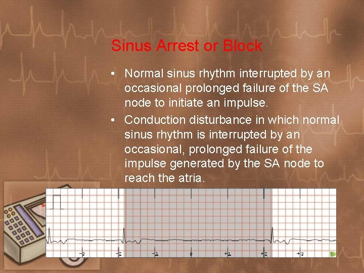 Sinus Arrest or Block • Normal sinus rhythm interrupted by an occasional prolonged failure