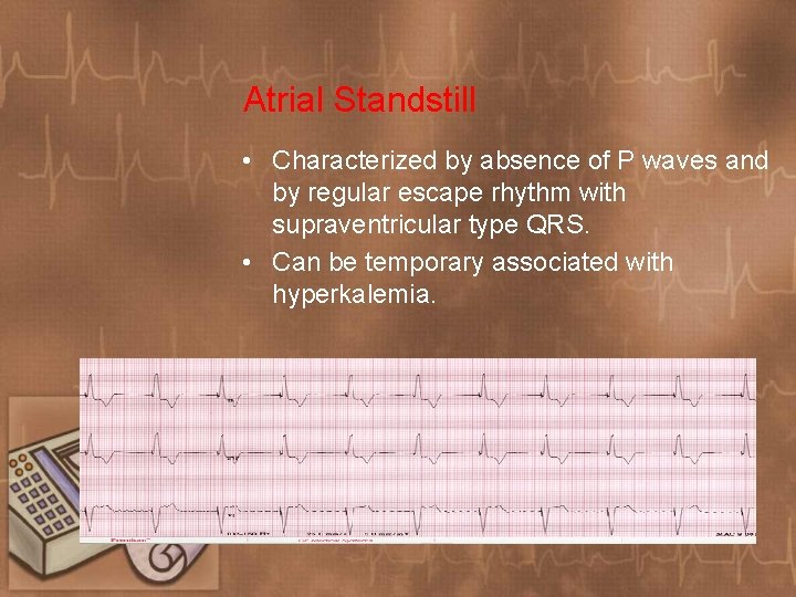 Atrial Standstill • Characterized by absence of P waves and by regular escape rhythm