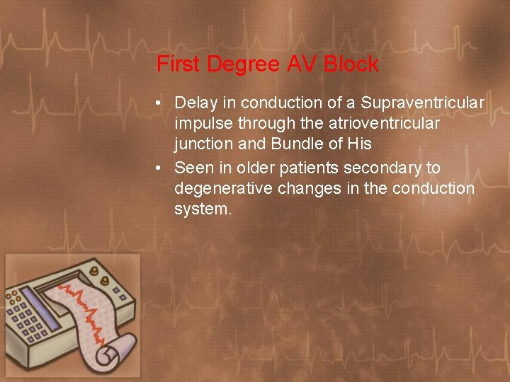 First Degree AV Block • Delay in conduction of a Supraventricular impulse through the