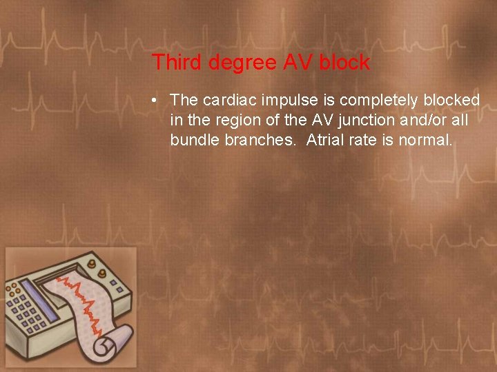 Third degree AV block • The cardiac impulse is completely blocked in the region