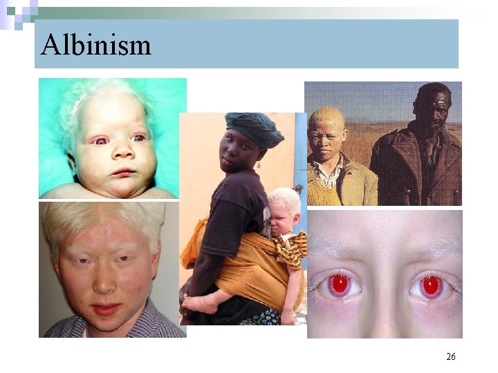 Albinism 26 