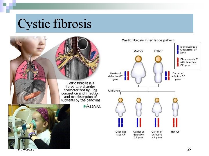 Cystic fibrosis 9/14/2021 29 