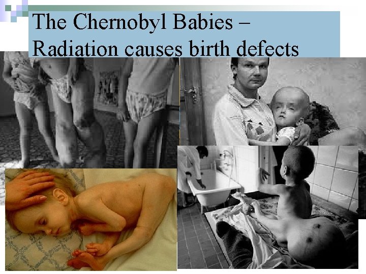 The Chernobyl Babies – Radiation causes birth defects 32 