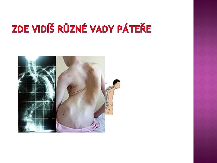 ZDE VIDÍŠ RŮZNÉ VADY PÁTEŘE 