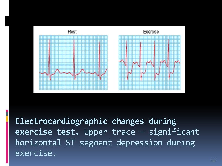 Electrocardiographic changes during exercise test. Upper trace – significant horizontal ST segment depression during