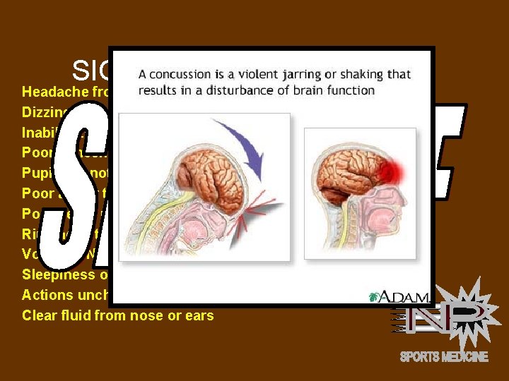 SIGNS OF A CONCUSSION Headache from the impact Dizziness and Confusion Inability to quickly